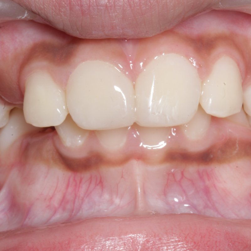 After composite work