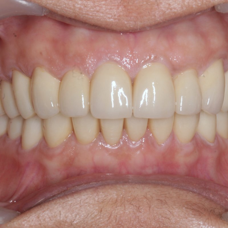 After full mouth rehabilitation