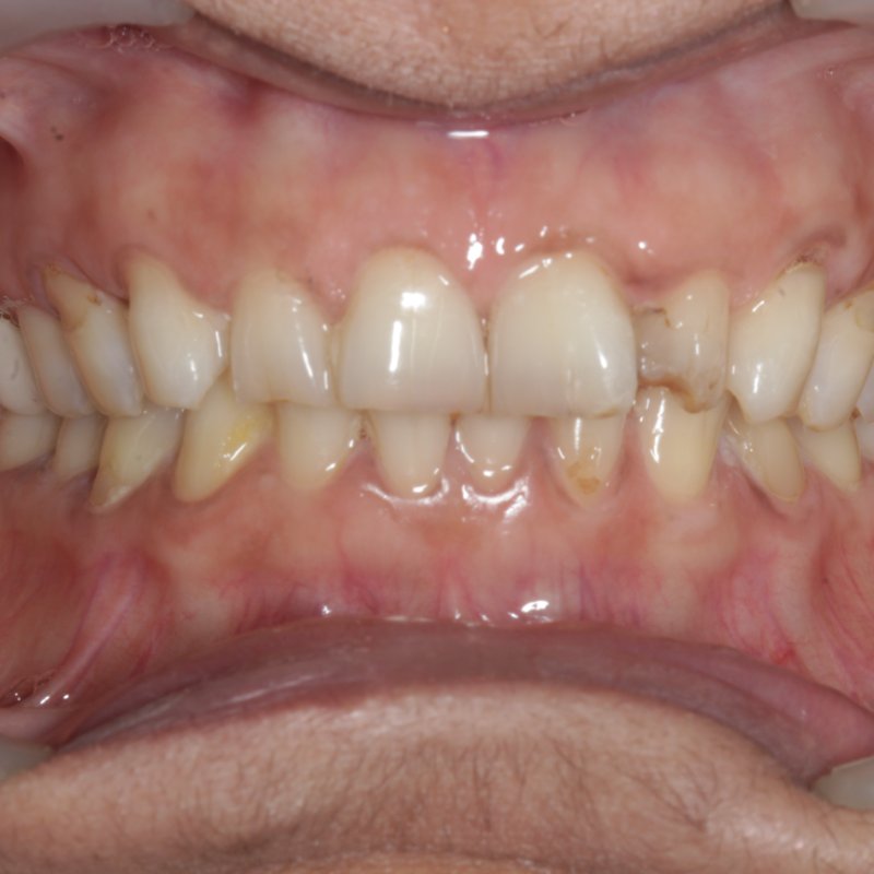 Before full mouth rehabilitation