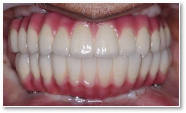 After full prosthetic restoration