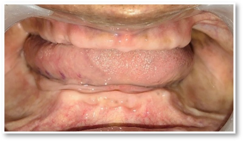 Before full prosthetic restoration