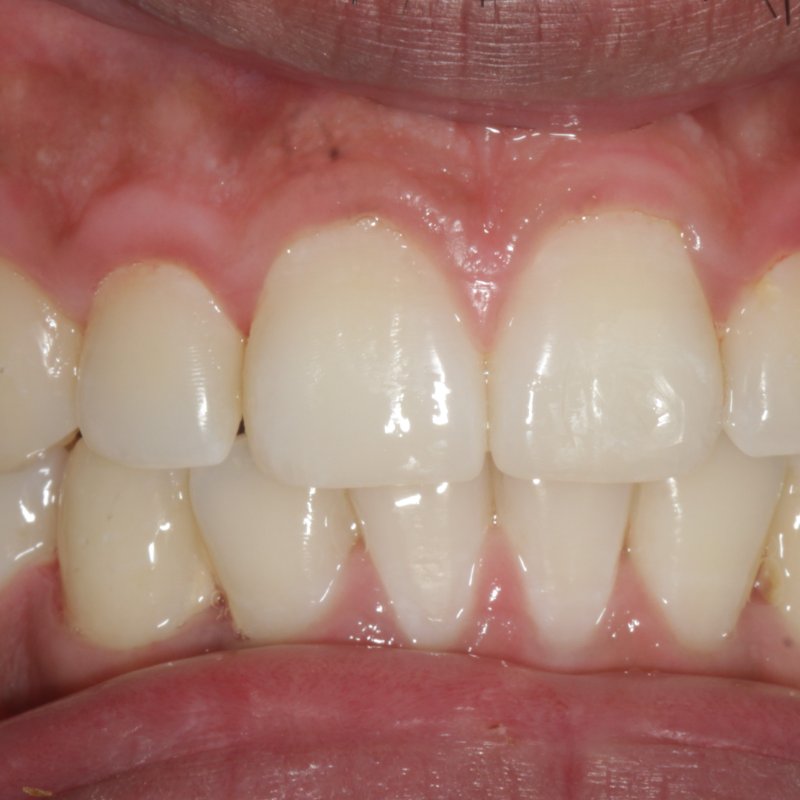 After invisalign treatment