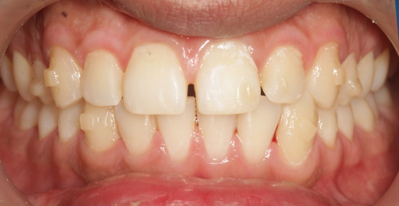 Before invisalign treatment