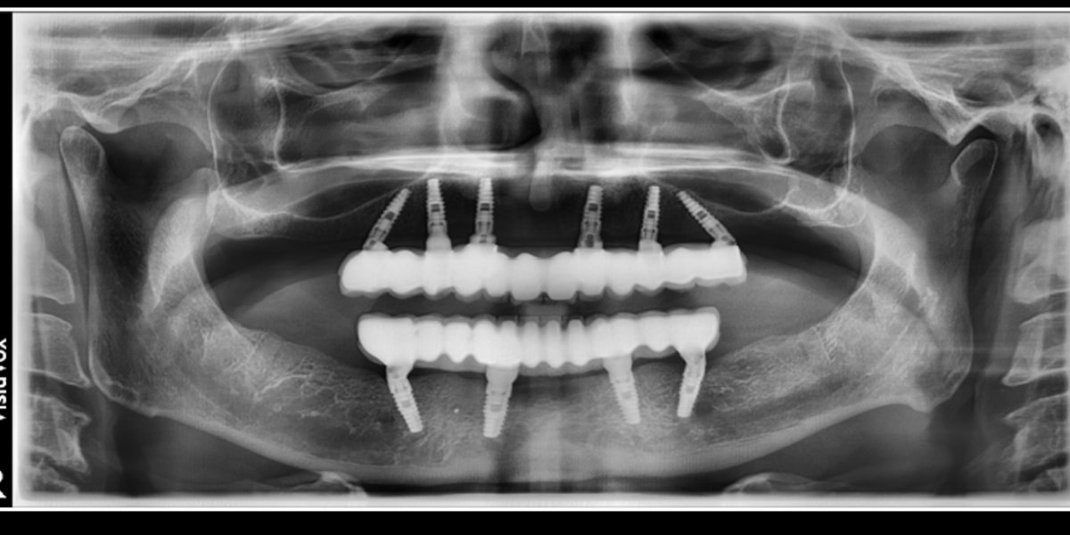 OPG x-ray after dental implants