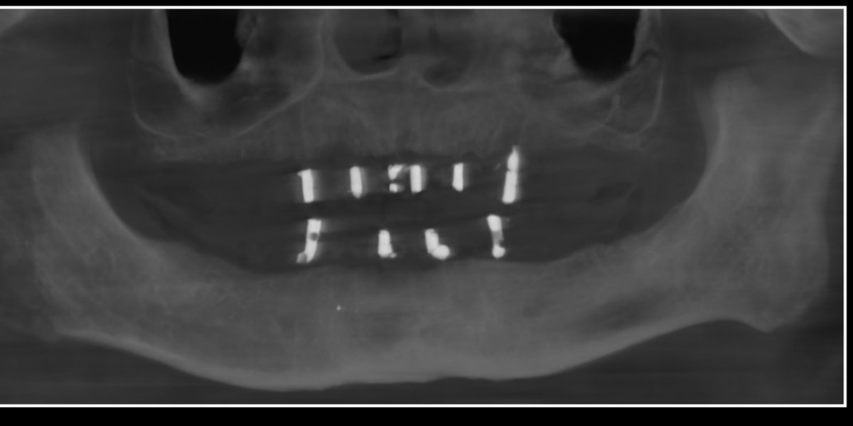 OPG x-ray before dental implants