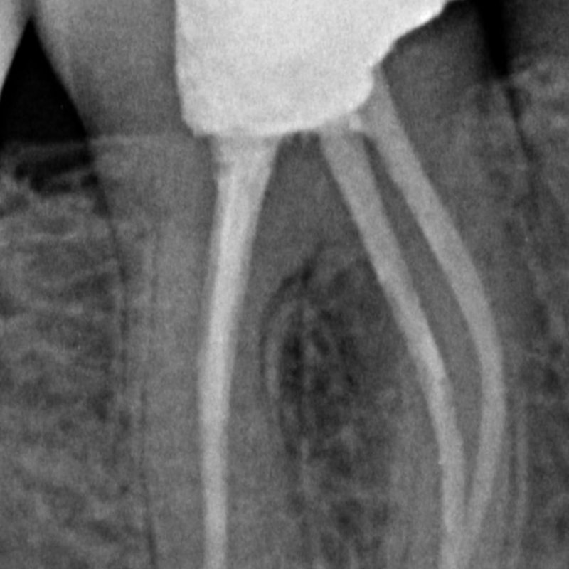X-ray after root canal treatment
