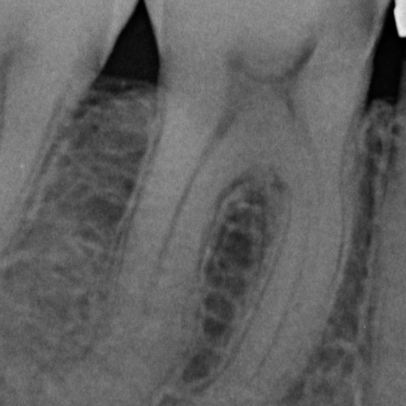 X-ray before root canal treatment