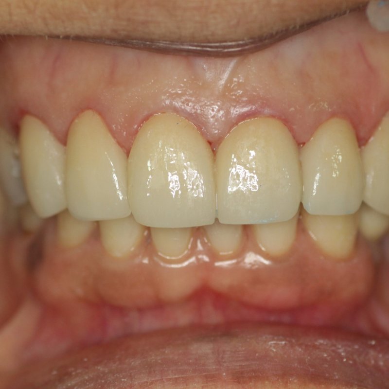 After smile makeover